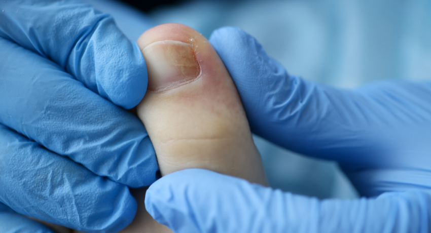 ingrown-nail-treatment-in-merritt